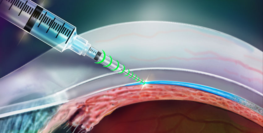 Smart needle